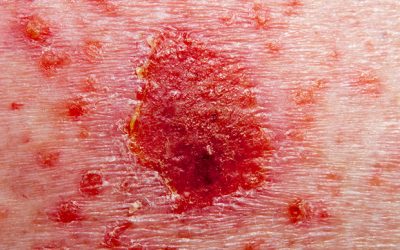 Novartis says Cosentyx safe and effective for five years