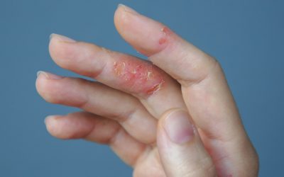 AbbVie’s Rinvoq shows potential for atopic dermatitis