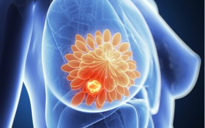 Thousands to benefit from five-minute breast cancer treatment