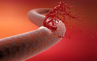 NICE backs restricted use of Ondexxya