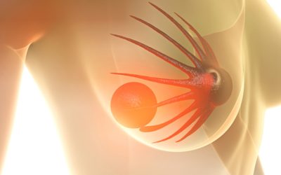 AstraZeneca focuses on breast cancer care transformation