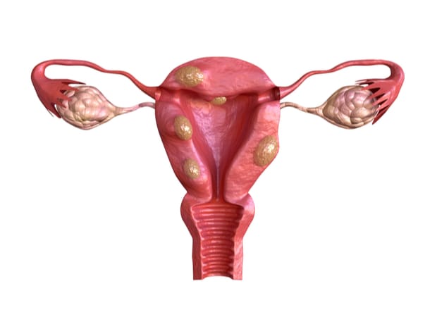 fibroid
