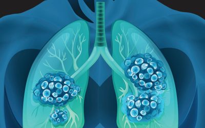 Keytruda/chemo combo extends survival in NSCLC patients