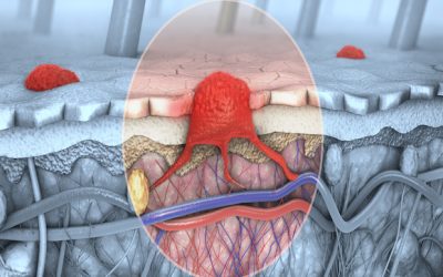 BMS’ Opdivo plus LAG-3 antibody relatlimab show promise in melanoma