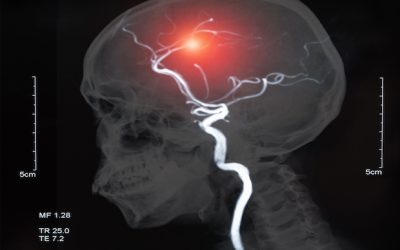 Researchers identify link between gum disease and young-onset stroke in patients